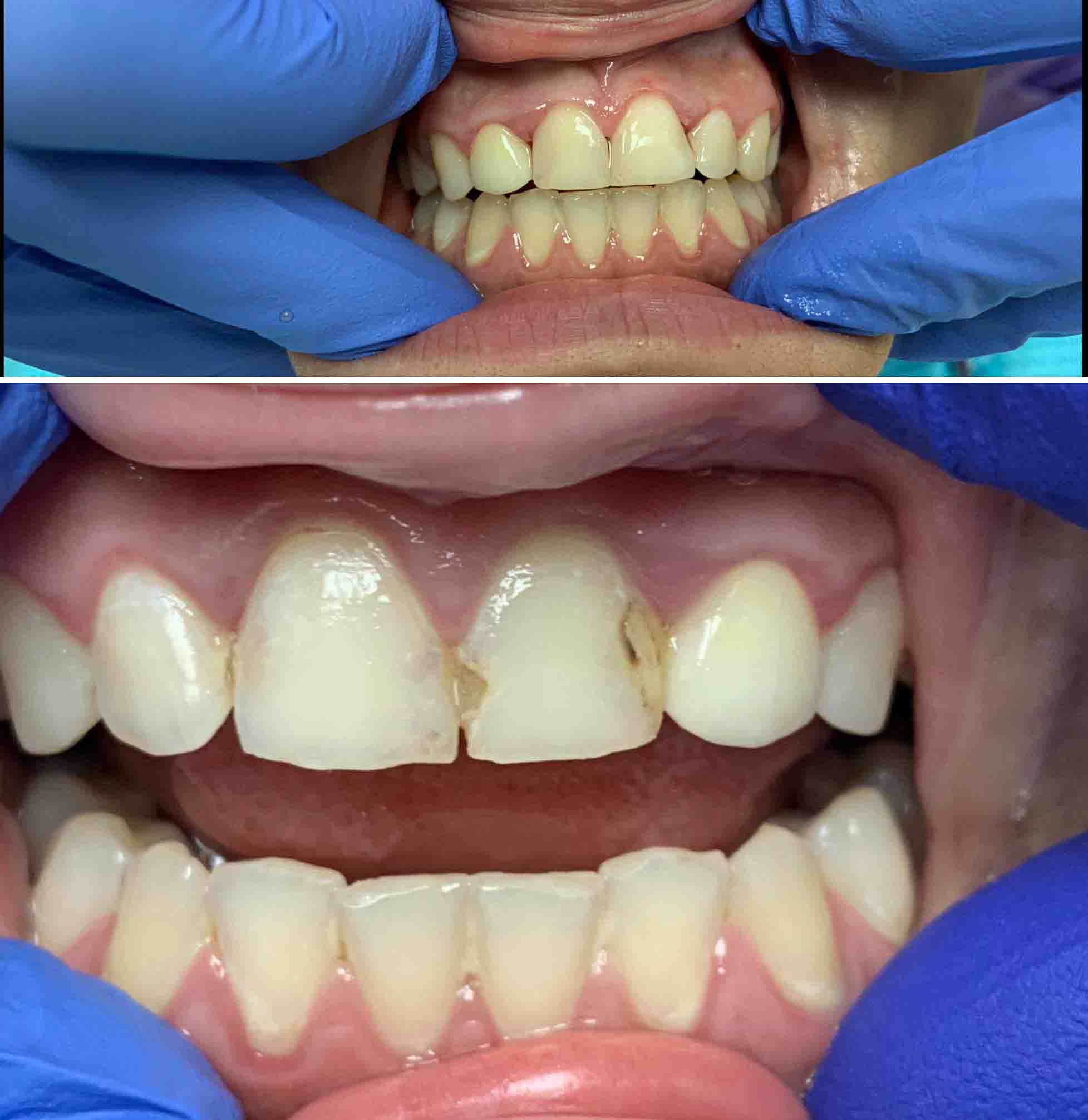 Recheios Dentários Frente Antes e Depois Cumming Dental Cumming GA Guinguette Marais Poitevin