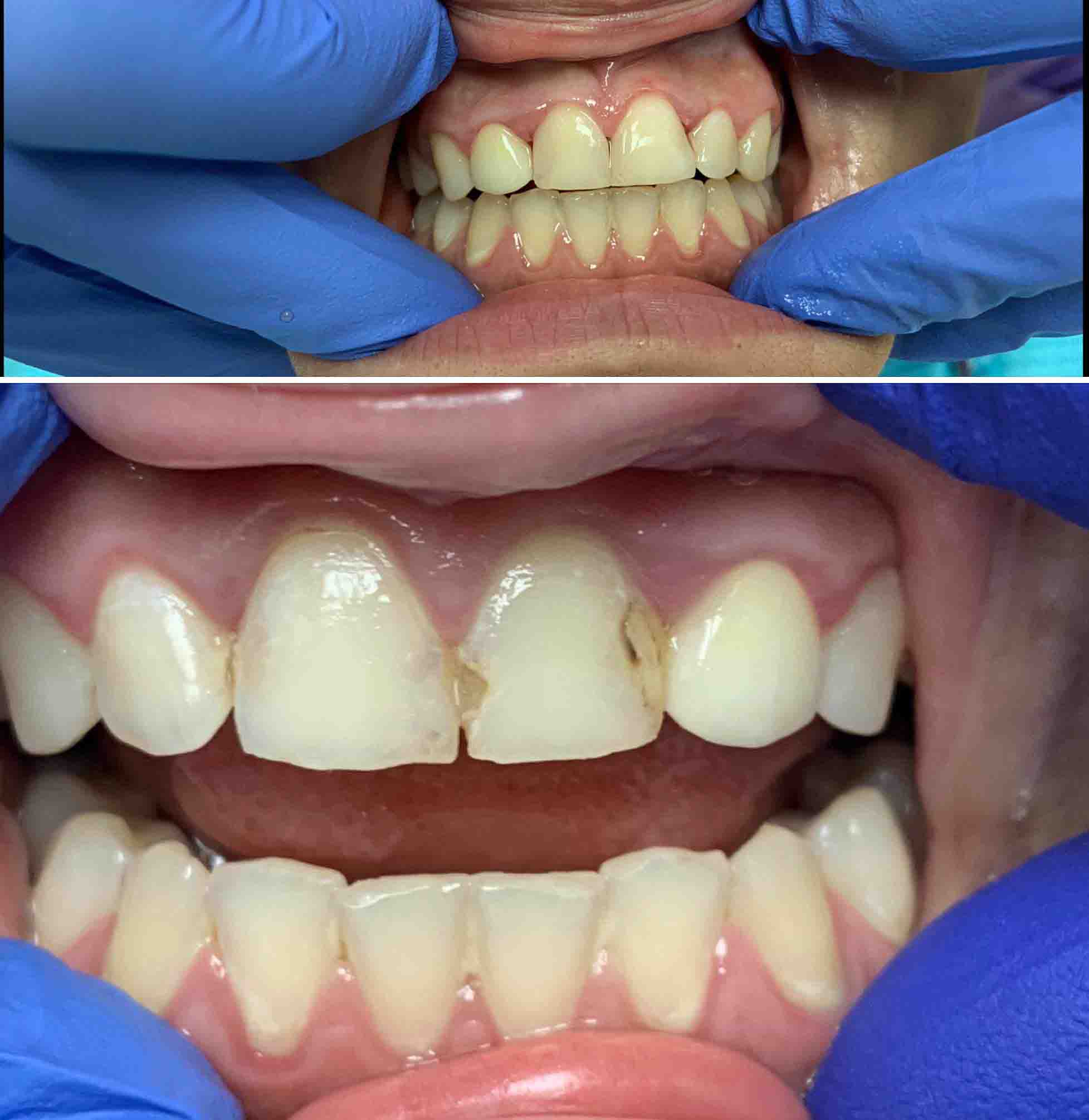 Recheios Dent rios Frente Antes E Depois Cumming Dental Cumming GA 