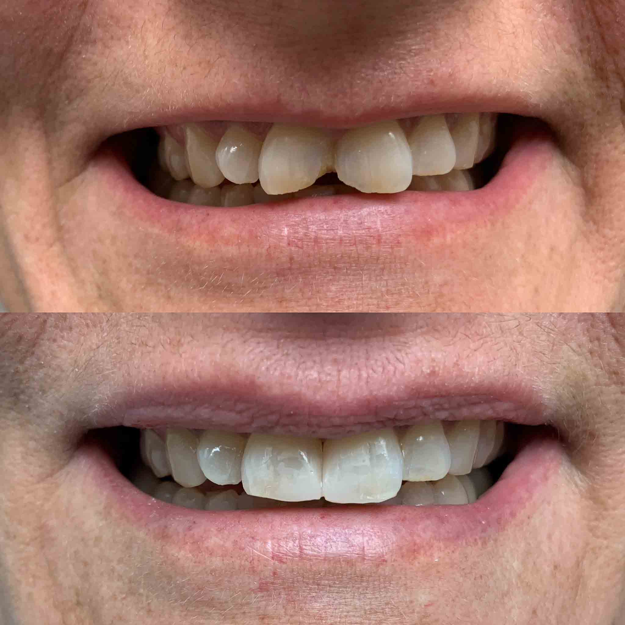cavities between front teeth